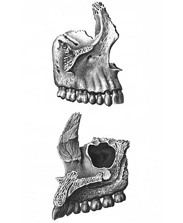иллюстрация к разделу: Верхняя челюсть